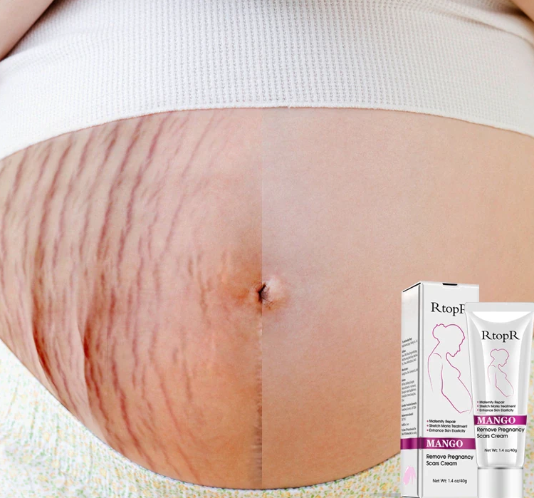 Mango Remove Pregnancy Scars Acne Cream Stretch Marks Treatment Maternity Repair Anti-Aging Anti Winkles Firming Body Creams