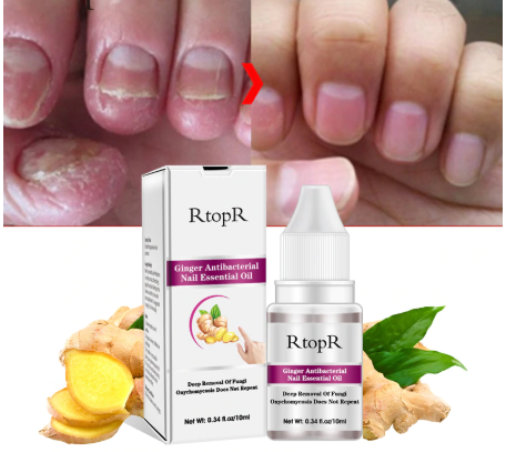 Ginger Antibacterial Nail Treatment Onychomycosis Paronychia Anti Fungal Nail Toe Nail Fungus Treatment Oil