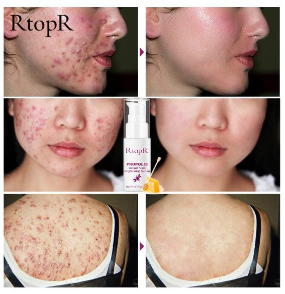 RtopR Propolis Repair Acne Brightening Serum Acne Scar Spots Cleaning Serum Acne Treatment Oil