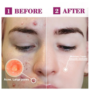 RtopR Propolis Repair Acne Brightening Serum Acne Scar Spots Cleaning Serum Acne Treatment Oil