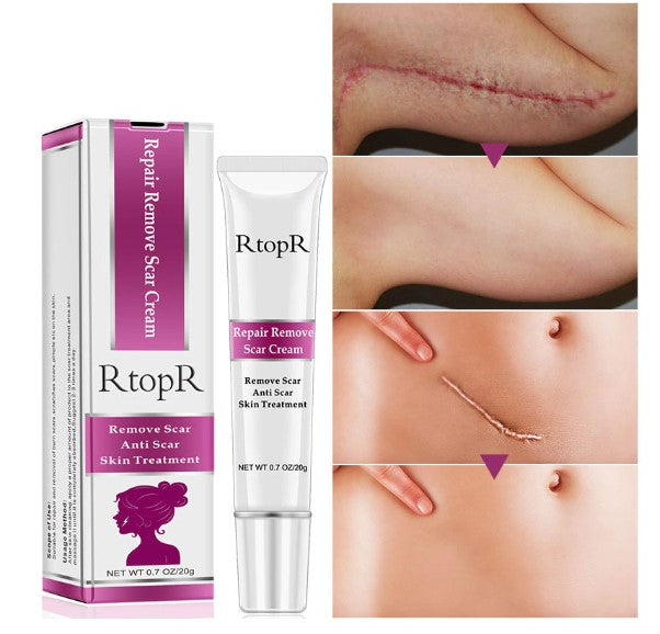 RtopR Acne Scar Stretch Marks Remover Cream Skin Repair Face Cream Acne Spots Acne Treatment Blackhead